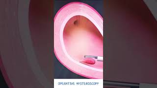 Operative Hysteroscopy  Fibroid amp Polyp removal  Hysteroscopic polypectomy  Types of Hysteroscope [upl. by Nyleahcim130]