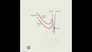 قسطرة مريض التصفية fistule arterioveineuse [upl. by Sheply]