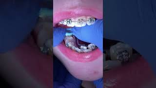 Orthodontic appliances 11 year old patient  RPE Upper and Lower  Tooth Time Family Dentistry [upl. by Fogarty206]