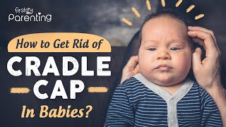 Cradle Cap in Babies  Causes and Remedies [upl. by Hickie920]