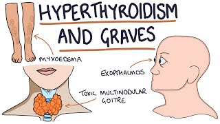 Understanding Hyperthyroidism and Graves Disease [upl. by Hatnamas]