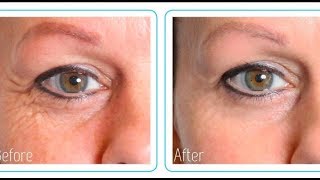 Hyaluronic Acid Before And After MY RESULTS [upl. by Sarina]