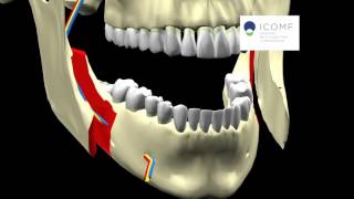 PROGNATISMO MANDIBULAR  OSTEOTOMIA SAGITAL [upl. by Ia312]