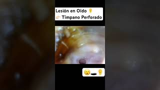 Un Tímpano Perforado 👂🏻😮 viralvideo shorts [upl. by Halyhs]