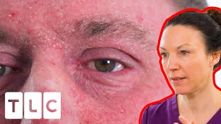 Agressive Eczema Is Ruining His Life  Bad Skin Clinic [upl. by Nojad]