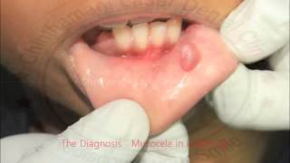 LASER TREATMENT FOR SWELLING IN THE LIPMUCOCELE [upl. by Kirsteni]