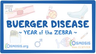 Buerger disease Year of the Zebra [upl. by Fisk580]