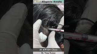 Alopecia Areata by intralesional injection alopecia areata treatment bald patches hair shorts [upl. by Nelrac]