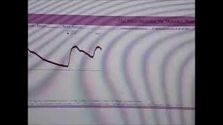 Part 4 DIY OXIMETER  pulse oximetry See your heart beats PVC detected too HRT and Arrhythmia [upl. by Whorton]