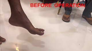 Before Operation and 2 Months after Operation Foot deformity Foot drop [upl. by Ecnarretal419]