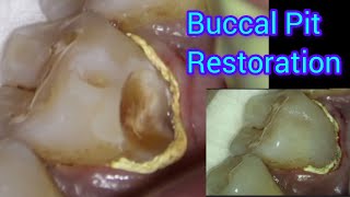 Deep Buccal Pit Restoration under Dental Operating Microscope  Composite Filling of Buccal Cavity [upl. by Aynekal]