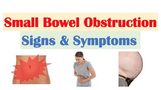 Small Bowel Obstruction SBO Signs amp Symptoms amp Why They Occur [upl. by Elstan]