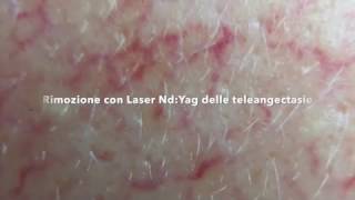 LASER  CAPILLARI TELEANGECTASIE  ROSACEA [upl. by Oecile253]