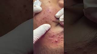 Best Pimple Popping 04 beautiful blackheads sacdepspa [upl. by Jade]