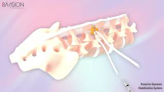 Posterior Dynamic Stabilization System [upl. by Fredrick]