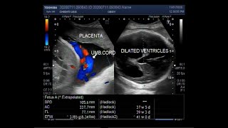 Ultrasound Video showing Cephalopelvic disproportion due to Hydrocephalus [upl. by Arlie649]