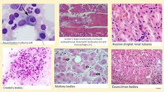 Mucoid amp Hyaline Degeneration [upl. by Alaaj]