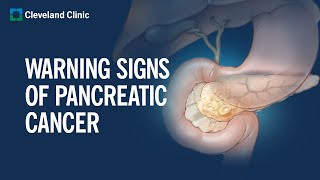 6 Warning Signs of Pancreatic Cancer [upl. by Notyal]