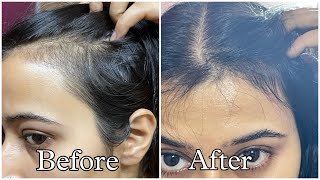 Best Hair Serums For Reduced Hair fall and Hair Growth [upl. by Ellan]