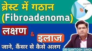 What is Fibroadenoma breast Cause amp Treatment Explained in hindi  Breast Me Ganth Ka ilaj [upl. by Ellehcir]