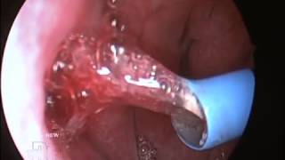 Eustachian Tube Surgery  The Drs Tv Sh0w [upl. by Harvard]