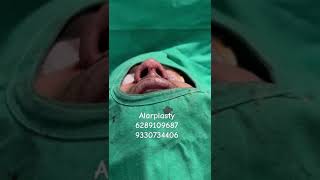 ALARPLASTYdranirbanghoshnosefillervasergynecomastiaaestheticsurgerynosejobs [upl. by Eilla5]