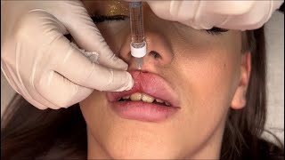 How to Safely Inject Lip Filler for Best Results [upl. by Anaoj]