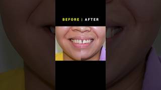 Braces for Gapped teeth 32 month Duration orthodontist braces dentist [upl. by Araas]