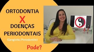 Ortodontia X Doenças Periodontais [upl. by Ppilihp]