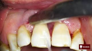 Advanced periodontal disease [upl. by Roderich]