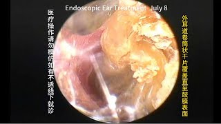 Ear blockage and removal of foreign objects [upl. by Payne]