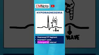 Electrolytes ECG Changes medical doctor nursing [upl. by Ayom361]