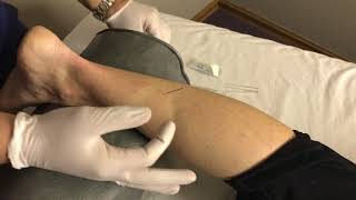 Dry Needling For Heel Pain In a Running Athlete  Columbus Ohio  Dr Daniel Leonard [upl. by Stavro]