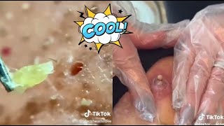 Ultimate Satisfying Acne Removal Compilation Best Pimple Pops Blackheads and Cysts [upl. by Ardyth]