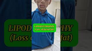 Lipodystrophy  lipoatrophy  signs amp symptoms [upl. by Aihseket]