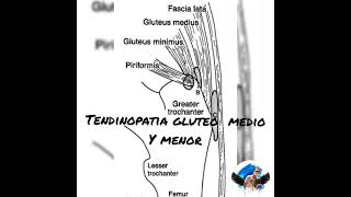 Tendinopatia glutea tratamiento [upl. by Linnie]