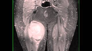 Synovial Sarcoma Thigh [upl. by Lehsar475]