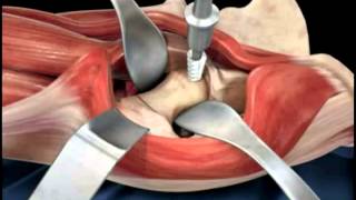 Hip replacement surgery techniques  Dr Scott Devinney [upl. by Saxena131]