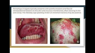 Autoimmune diseases pemphigus vulgaris vs bullous pemphigoid [upl. by Sandstrom777]