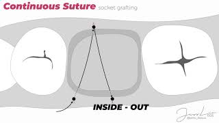 Socket Grafting Suturing Technique [upl. by Anyzratak147]