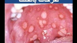 متلازمة بهجت للدكتور فهيد السبيعي BEHCETS DISEASE DRFOHEID ALSOBEI [upl. by Agnew525]