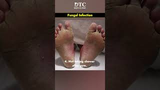 What is Fungal Infection amp Its Treatment  DTC Skin Clinic [upl. by Persons]