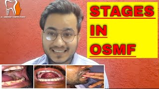 STAGES IN OSMF IN HINDI EARLY AND ADVANCED STAGES ORAL SUBMUCOUS FIBROSIS STAGES DRCHANDER UDHEY [upl. by Amund460]