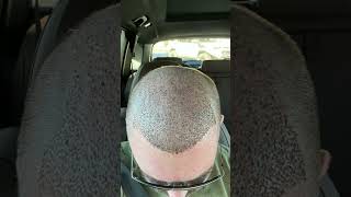 Hair Transplant in Turkey  Hair Transplant before after hairtransplant [upl. by Der]