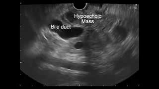 Endoscopic ultrasound FNA of a pancreatic mass [upl. by Hansiain]