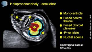 Semilobar holoprosencephaly 2D and 3D ultrasound [upl. by Weitman]