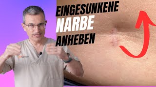 Eingesunkene Narbe nach OP behandeln Dr Kasten Hautmedizin in Mainz [upl. by Htebsle]