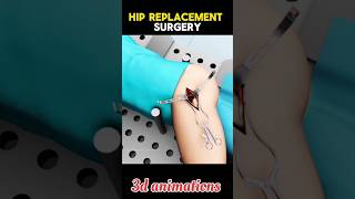 Hip Replacement Surgery Process shorts viral hipsurgery 3d [upl. by Hiro]