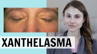 XANTHELASMA WHAT IT IS amp HOW IT IS TREATED DR DRAY [upl. by Eletnahs]