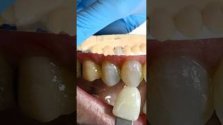 Signature Premolar ​⁠EnvisiontecMain envisiontec lsk121shorts dentistteeth [upl. by Benedict]